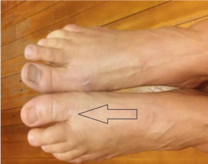 Kelly's swollen toe 